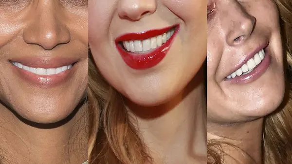 Tratamientos detrás de las sonrisas perfectas mujeres famosas